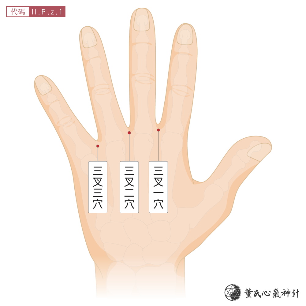 三叉穴位於掌骨背面三叉區左手示意圖