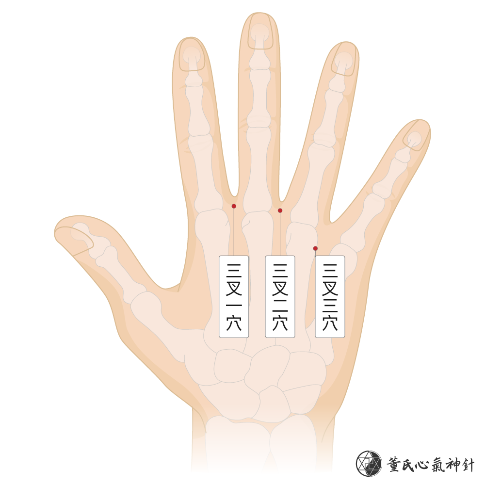 三叉穴位於掌骨背面三叉區右手示意圖